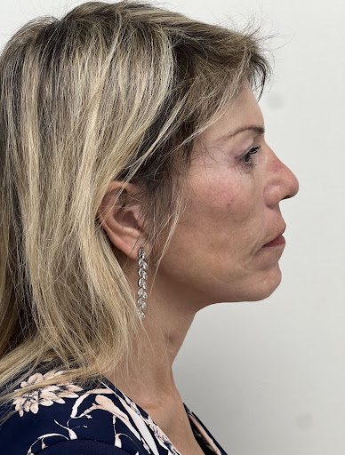 Facelift with Upper & Lower Bleph