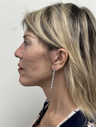 Facelift with Upper & Lower Bleph