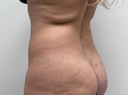 Liposuction & Mini Tuck