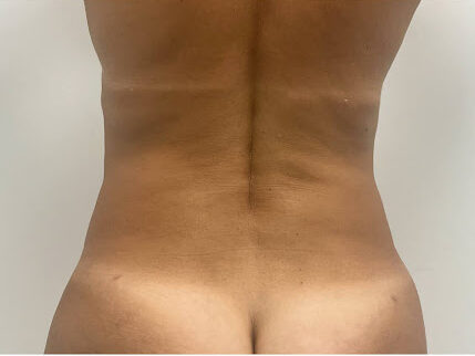 Liposuction & Mini Tuck
