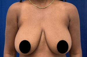 Le Spa Plastic Surgery Before and After Photos