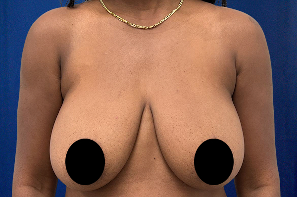 Breast Lift Before & After Photos