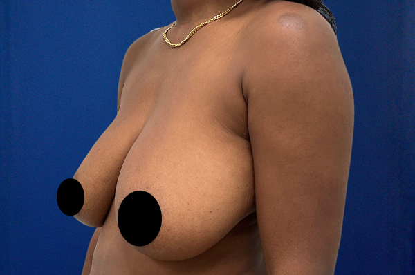 Breast Lift Before & After Photos