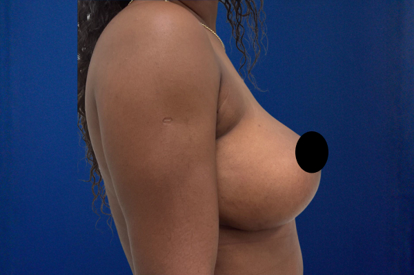 Breast Lift Before & After Photos