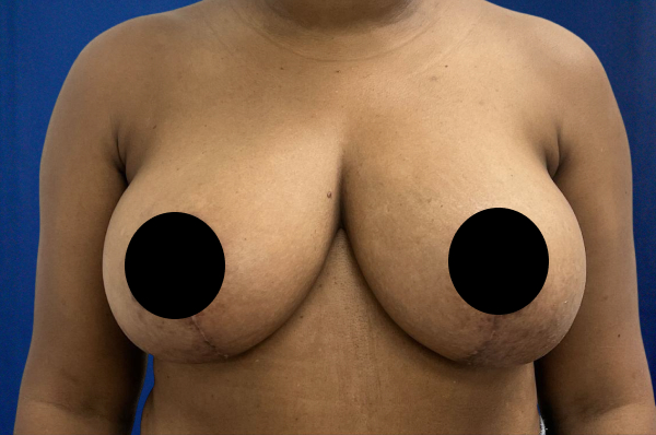 Breast Reduction