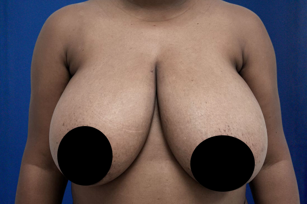 Breast Reduction