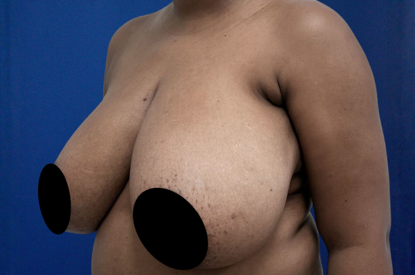 Breast Reduction