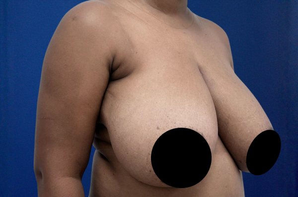 Breast Reduction