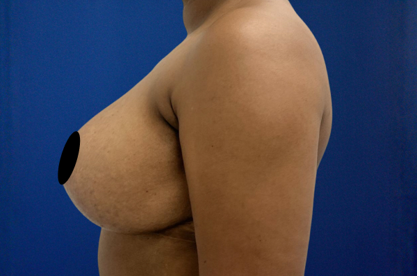 Breast Reduction