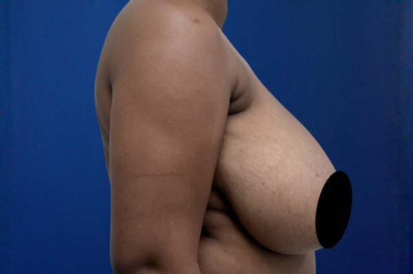 Breast Reduction