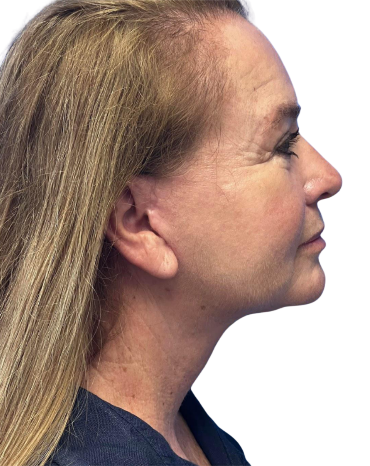 Facelift