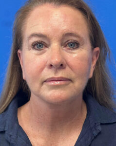 Le Spa Plastic Surgery Before and After Photos