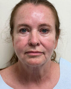 Le Spa Plastic Surgery Before and After Photos