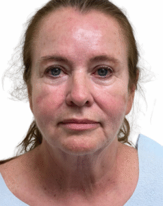 Le Spa Plastic Surgery Before and After Photos