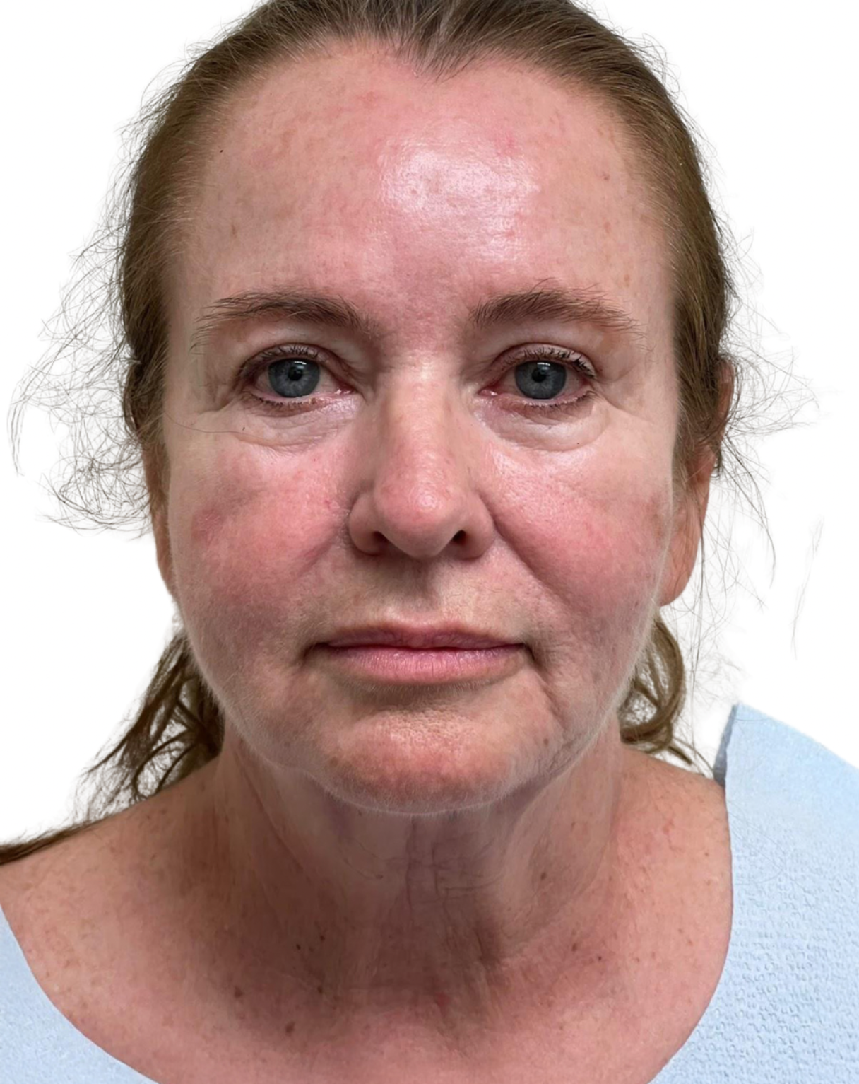 Facelift