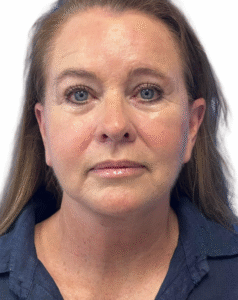 Le Spa Plastic Surgery Before and After Photos