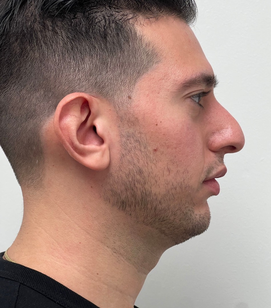 Rhinoplasty