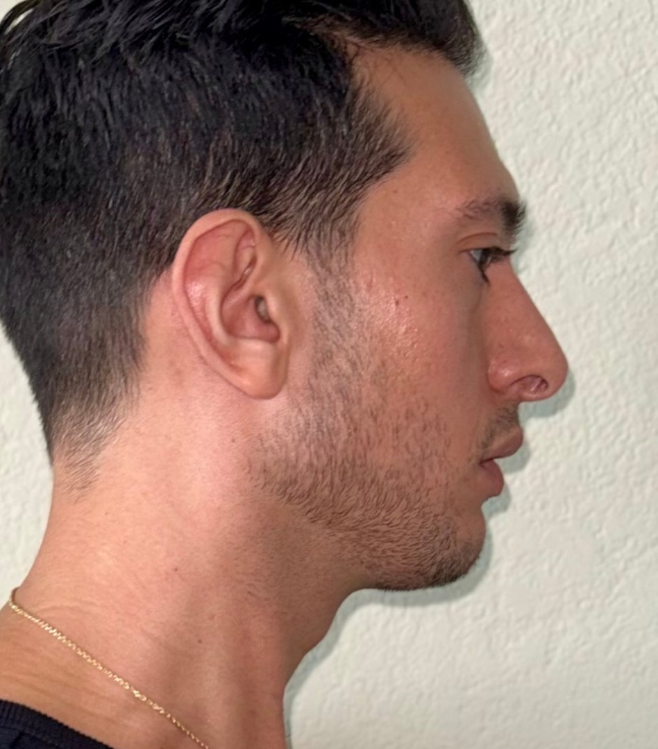 Rhinoplasty