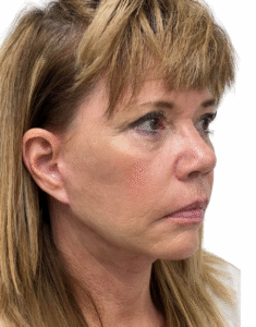 Le Spa Plastic Surgery Before and After Photos