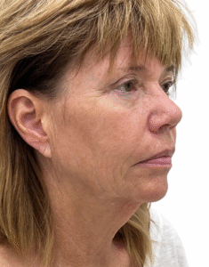 Le Spa Plastic Surgery Before and After Photos