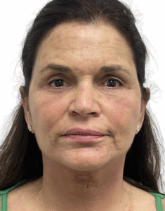 Le Spa Plastic Surgery Before and After Photos