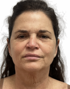 Le Spa Plastic Surgery Before and After Photos