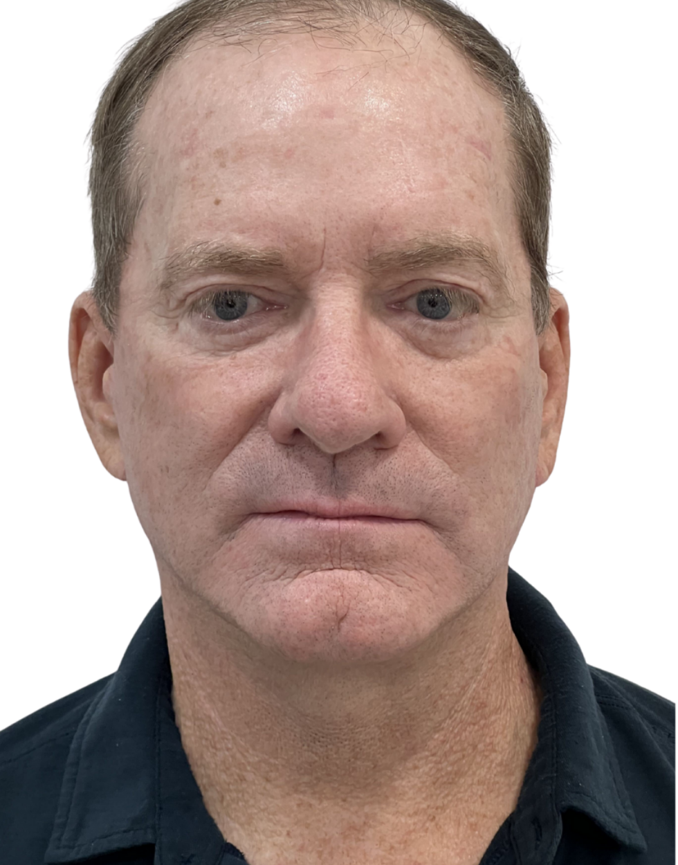 Facelift