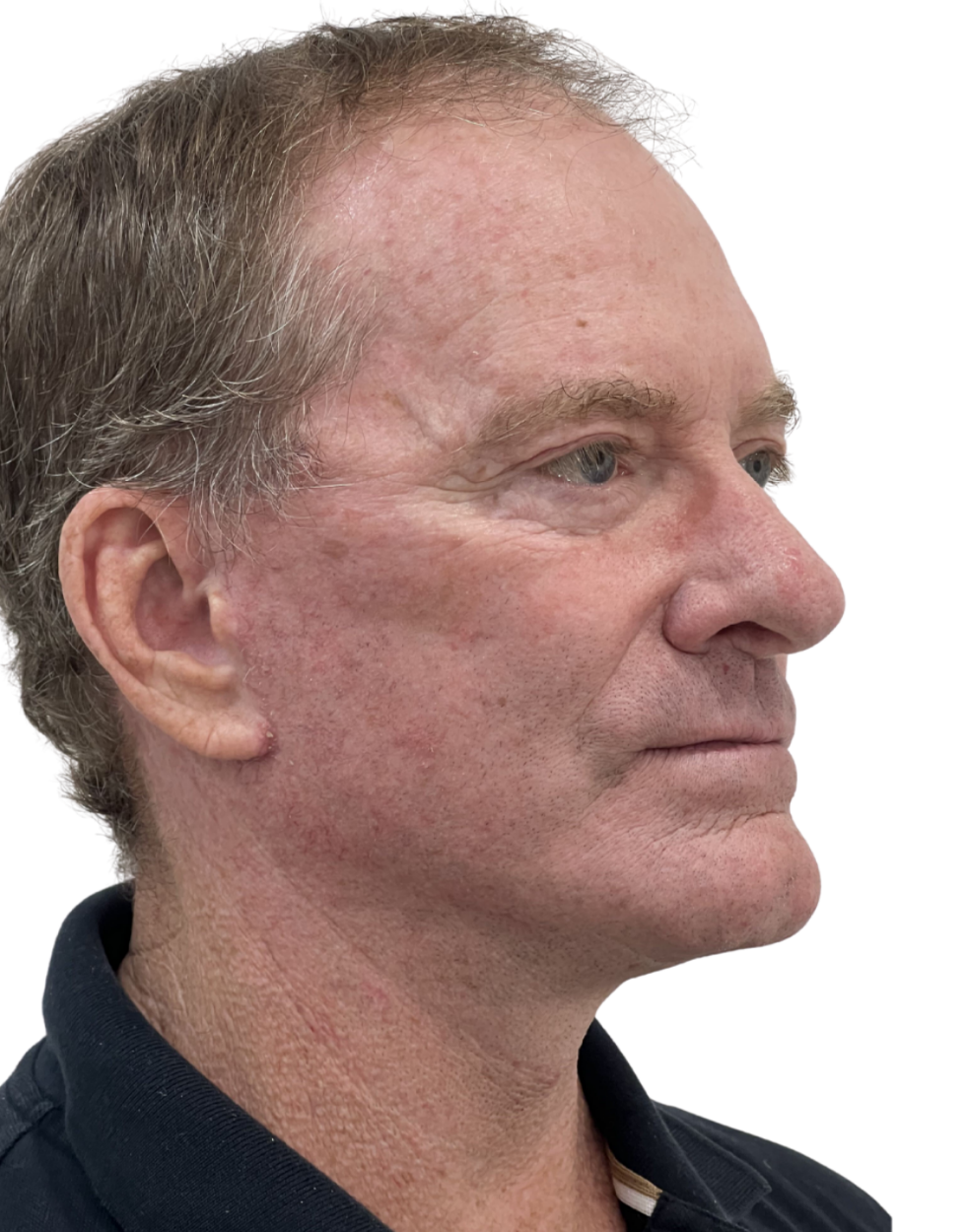 Facelift