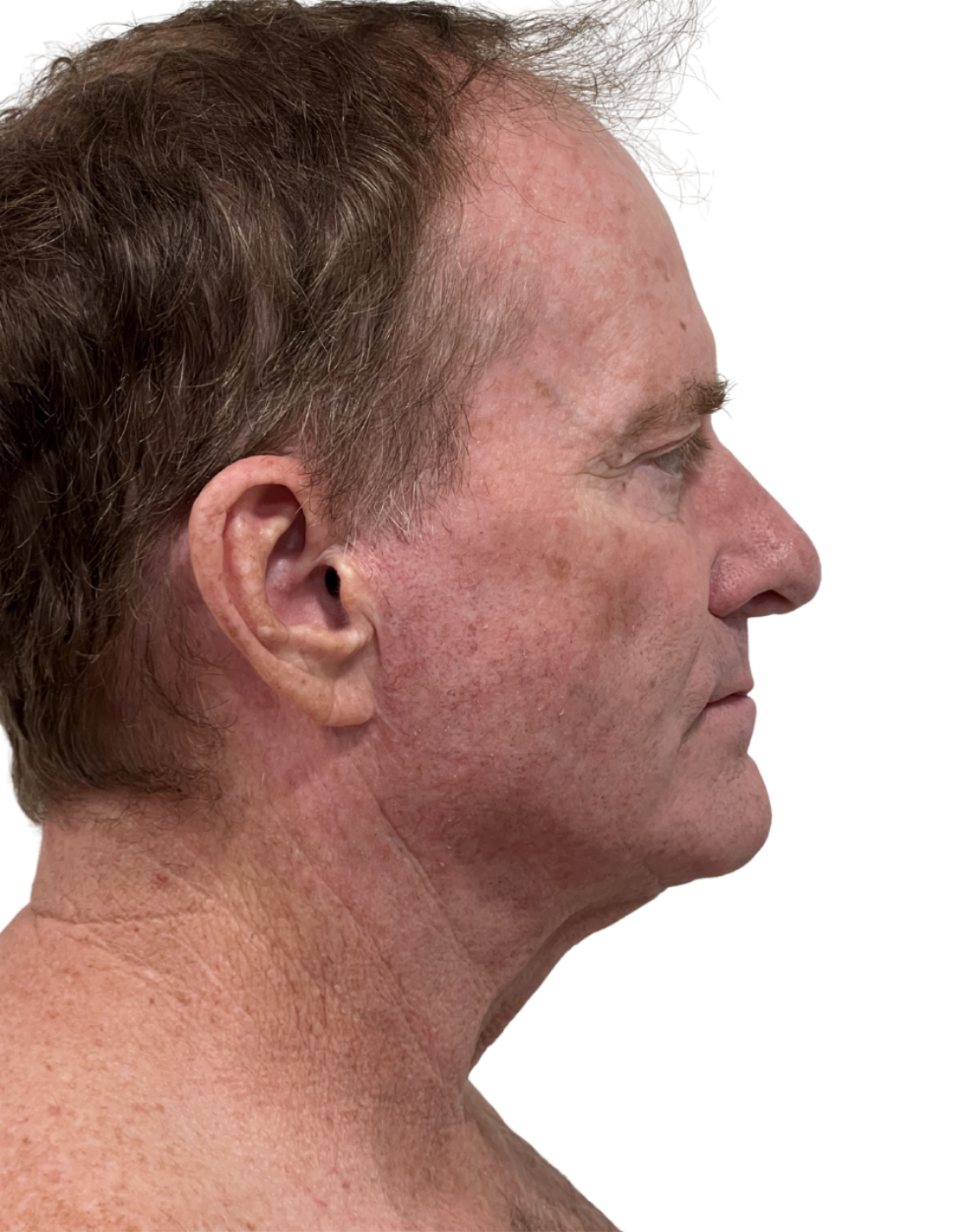 Facelift