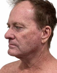 Le Spa Plastic Surgery Before and After Photos