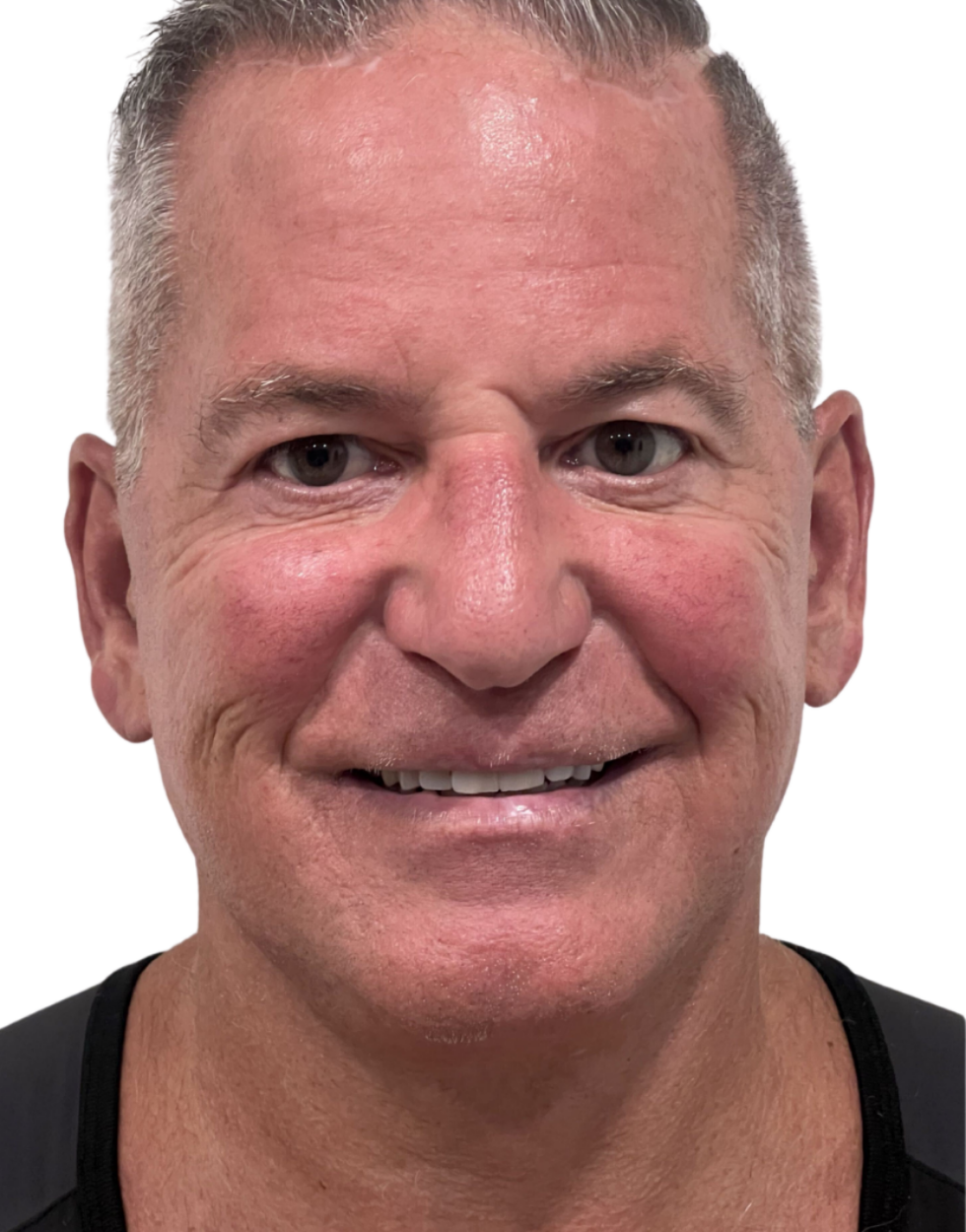 Facelift