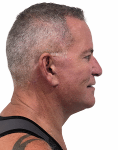 Le Spa Plastic Surgery Before and After Photos