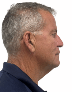 Le Spa Plastic Surgery Before and After Photos