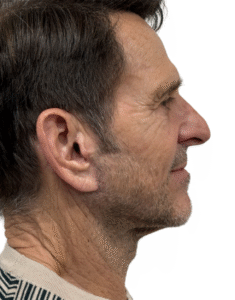 Le Spa Plastic Surgery Before and After Photos