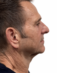 Le Spa Plastic Surgery Before and After Photos